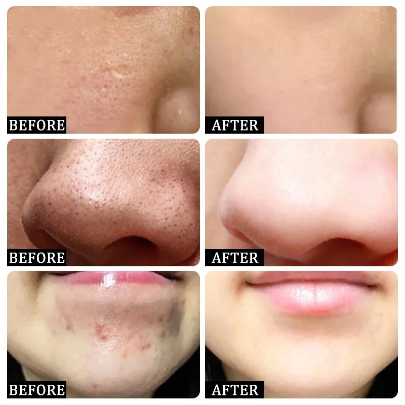 Salicylic Acid Pore Clearing C - Salicylic Acid Blackhead Remover review and price