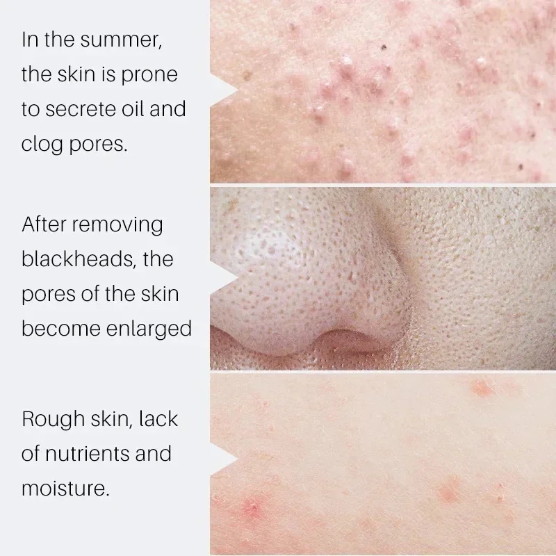 Salicylic Acid Pore Shrinking  - Salicylic Acid Blackhead Remover review and price