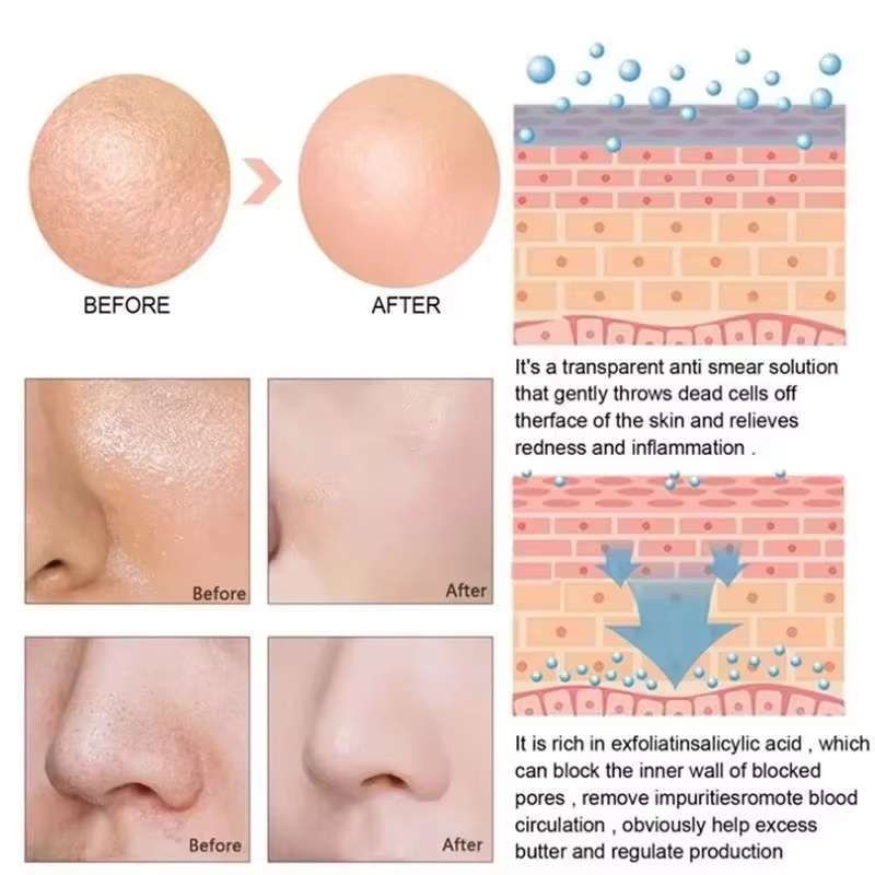 Salicylic Acid Pore Shrinking  - Salicylic Acid Blackhead Remover review and price