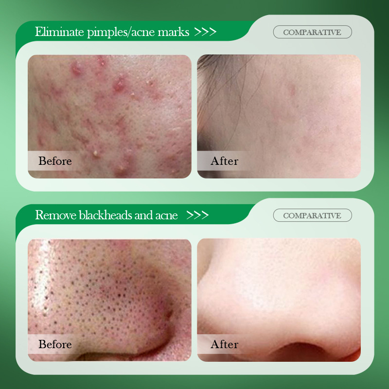 Salicylic Acid Acne Treatment  - Salicylic Acid Blackhead Remover review and price